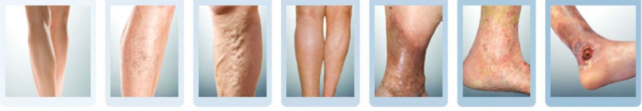 stages of varicose veins of the legs