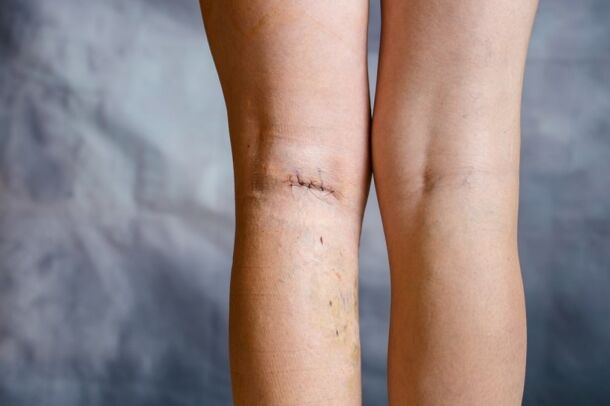 leg suture after varicose vein surgery