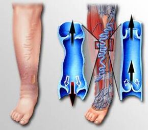 blood flow to the leg with varicose veins
