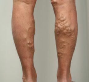 knots in the legs with varicose veins