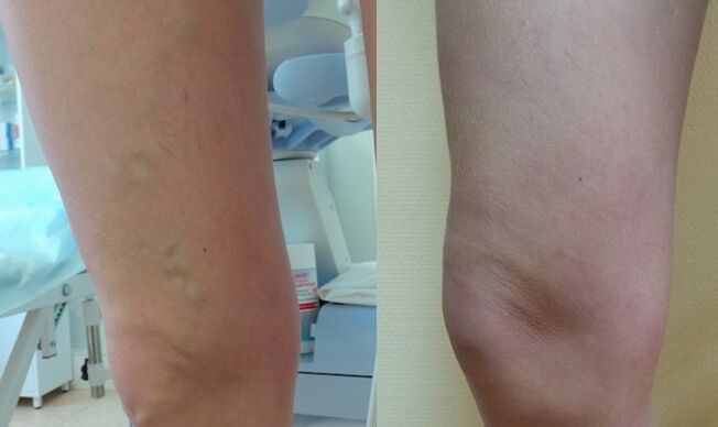 leg before and after treatment of retinal varicose veins
