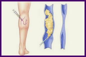 Sclerotherapy is a popular method of getting rid of varicose veins in the legs
