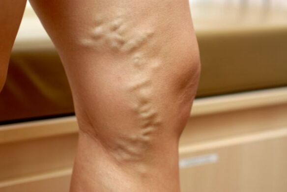 varicose veins in the leg with varicose veins of the small pelvis