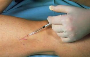 how to treat varicose veins of the legs.