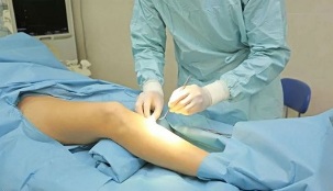 how varicose vein surgery is performed