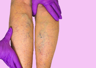 reasons for the appearance of varicose veins