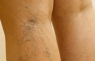 the treatment of varicose veins of the legs.