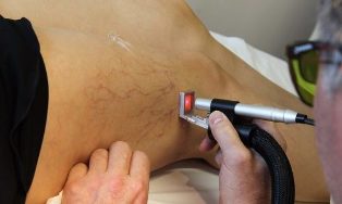 the treatment of varicose veins, laser