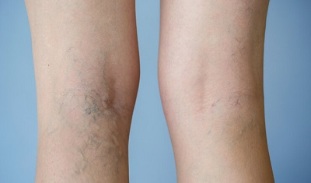 Signs of varicose veins on the legs in women