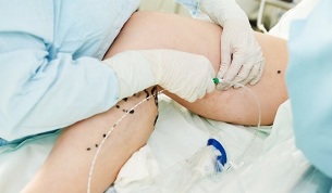 methods of treating varicose veins in women