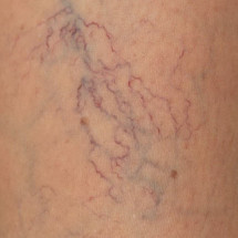 The symptoms of varicose veins