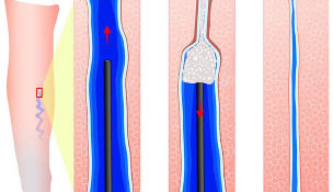 The introduction of the sclerosant during sclerotherapy