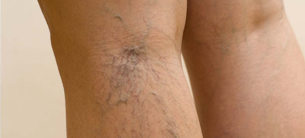Varicose veins in the legs.