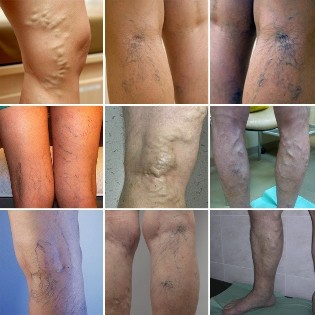 Pictures of varicose veins of the lower limbs